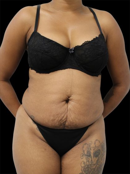 Tummy Tuck Before & After Patient #2846