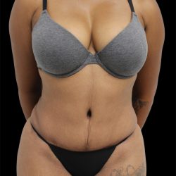 Tummy Tuck Before & After Patient #2846