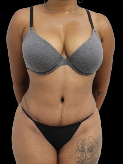 Tummy Tuck Before & After Patient #2846