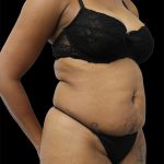 Tummy Tuck Before & After Patient #2846