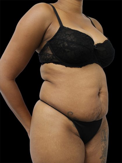 Tummy Tuck Before & After Patient #2846