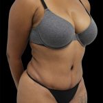 Tummy Tuck Before & After Patient #2846