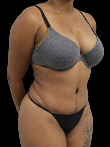 Tummy Tuck Before & After Patient #2846