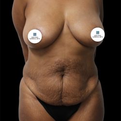 Tummy Tuck Before & After Patient #2885