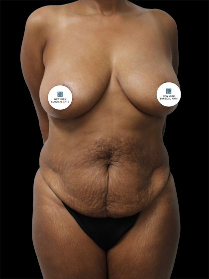 Tummy Tuck Before & After Patient #2885