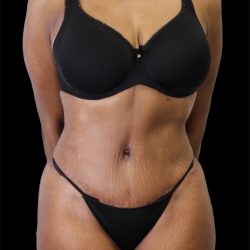 Tummy Tuck Before & After Patient #2885
