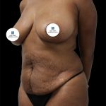 Tummy Tuck Before & After Patient #2885