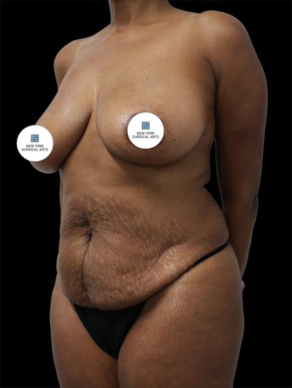 Tummy Tuck Before & After Patient #2885