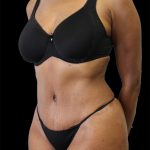 Tummy Tuck Before & After Patient #2885