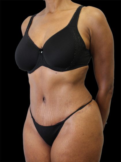 Tummy Tuck Before & After Patient #2885