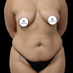 Tummy Tuck Before & After Patient #2886