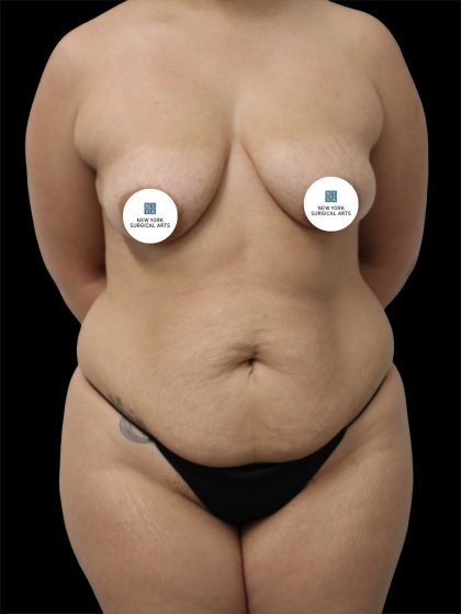 Tummy Tuck Before & After Patient #2886
