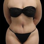 Tummy Tuck Before & After Patient #2886