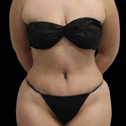 Tummy Tuck Before & After Patient #2886