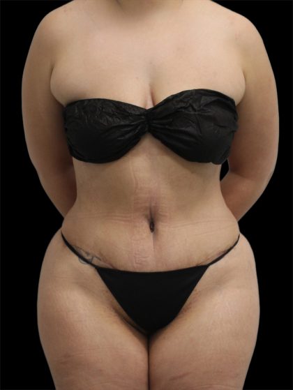 Tummy Tuck Before & After Patient #2886
