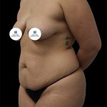 Tummy Tuck Before & After Patient #2886