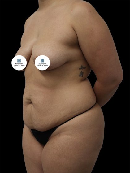 Tummy Tuck Before & After Patient #2886