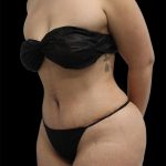 Tummy Tuck Before & After Patient #2886