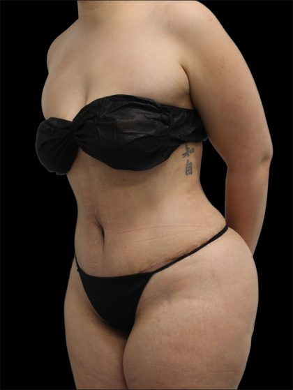 Tummy Tuck Before & After Patient #2886