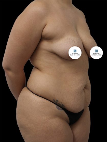 Tummy Tuck Before & After Patient #2887