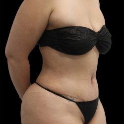 Tummy Tuck Before & After Patient #2887