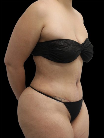 Tummy Tuck Before & After Patient #2887