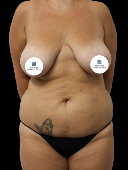 Tummy Tuck Before & After Patient #2888