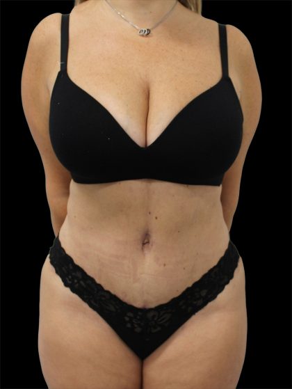 Tummy Tuck Before & After Patient #2888