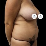 Tummy Tuck Before & After Patient #2888