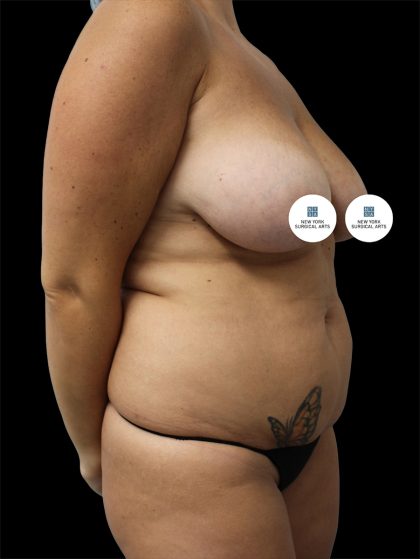 Tummy Tuck Before & After Patient #2888