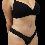 Tummy Tuck Before & After Patient #2888