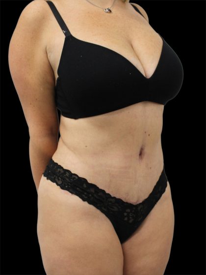 Tummy Tuck Before & After Patient #2888