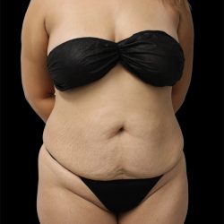 Tummy Tuck Before & After Patient #2889