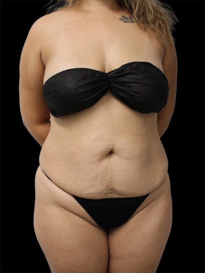 Tummy Tuck Before & After Patient #2889