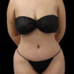 Tummy Tuck Before & After Patient #2889