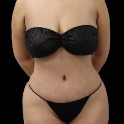 Tummy Tuck Before & After Patient #2889