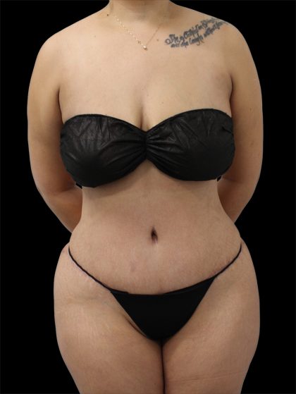 Tummy Tuck Before & After Patient #2889