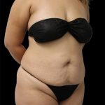 Tummy Tuck Before & After Patient #2889