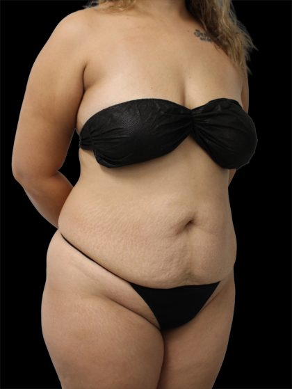 Tummy Tuck Before & After Patient #2889