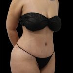 Tummy Tuck Before & After Patient #2889