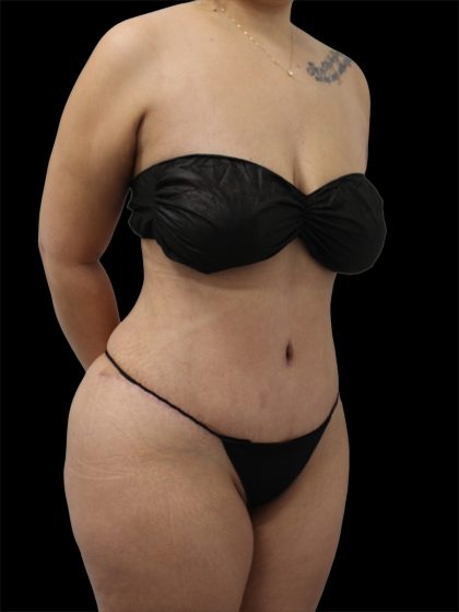 Tummy Tuck Before & After Patient #2889