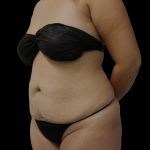 Tummy Tuck Before & After Patient #2889