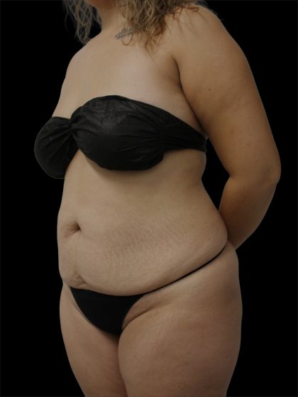 Tummy Tuck Before & After Patient #2889