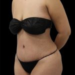 Tummy Tuck Before & After Patient #2889
