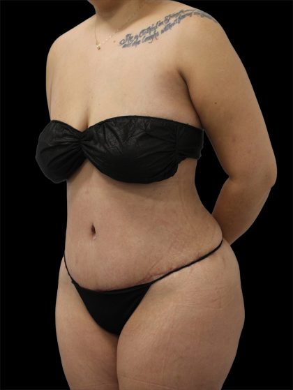 Tummy Tuck Before & After Patient #2889