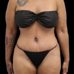 Tummy Tuck Before & After Patient #2890