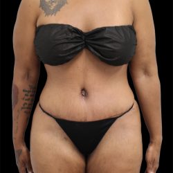 Tummy Tuck Before & After Patient #2890