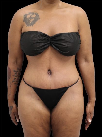 Tummy Tuck Before & After Patient #2890