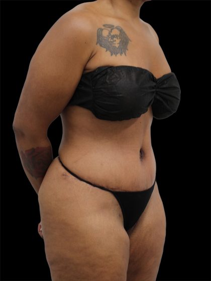 Tummy Tuck Before & After Patient #2890