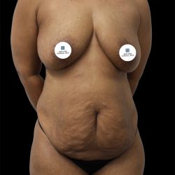 Tummy Tuck Before & After Patient #2891